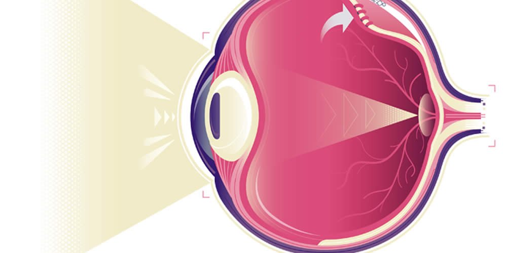 O que é o descolamento de retina