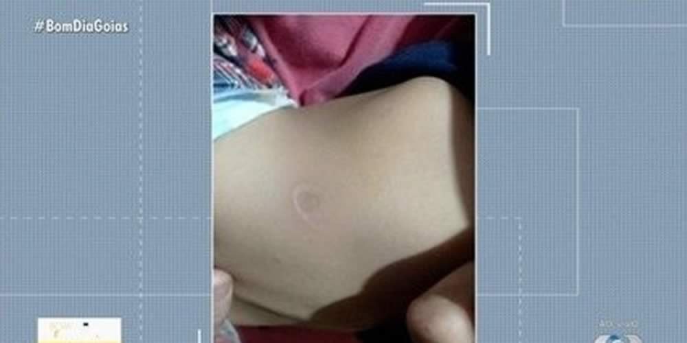 Mãe é suspeita de queimar bebê com cigarro, em Rio Verde