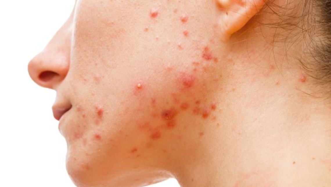 Sociedade médica alerta para uso indevido do remédios para acnes