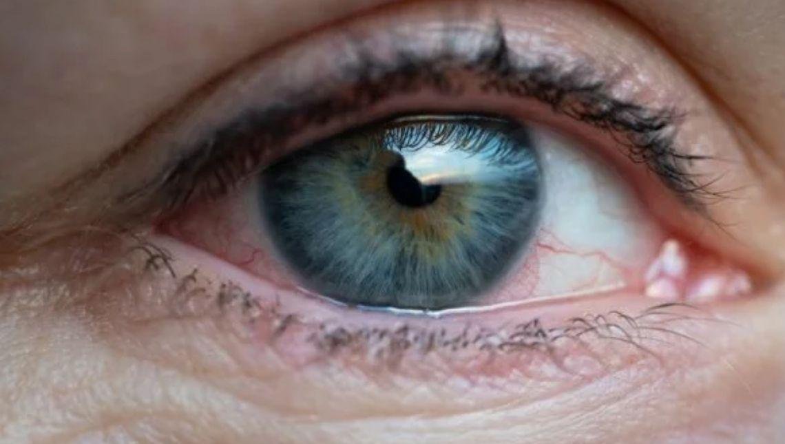 Glaucoma saiba como controlar doença que pode levar à cegueira