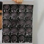 Cansaço persistente pode ser sintoma de Síndrome da Fadiga Crônica