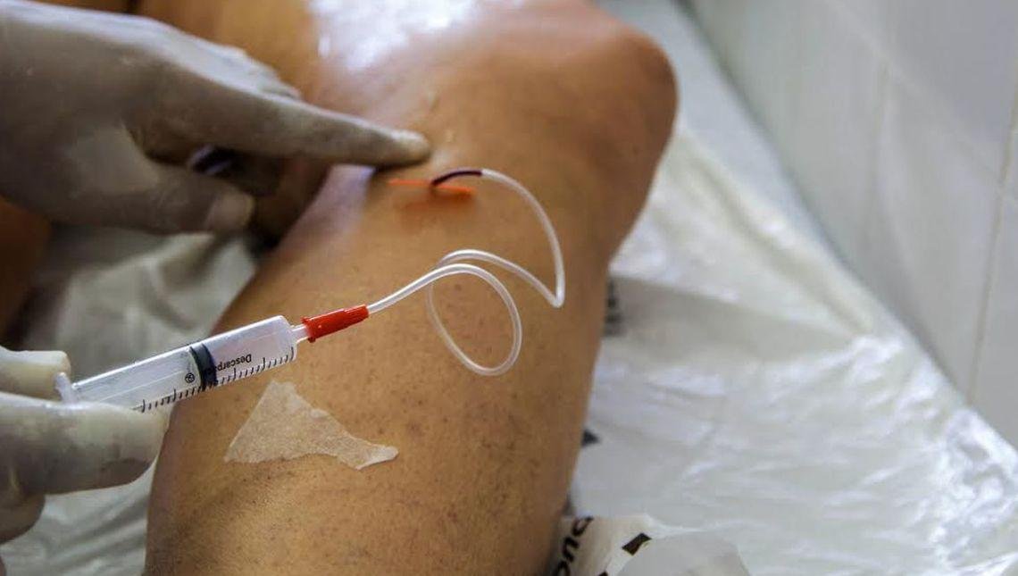 Doença venosa crônica é fator de risco para problemas cardiovasculares