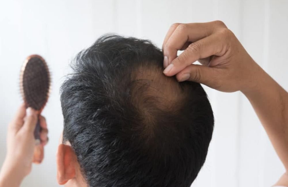 Minoxidil: uso de remédio contra calvície divide especialistas