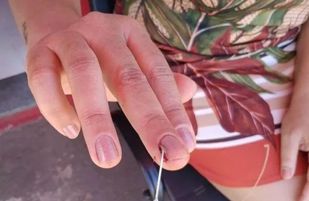 Mulher atravessa dedo com anzol de pesca em Jataí