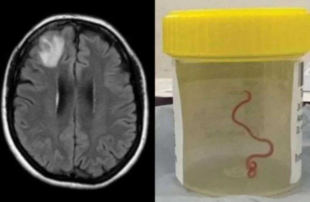 Verme de 8 cm é encontrado em cérebro humano pela primeira vez
