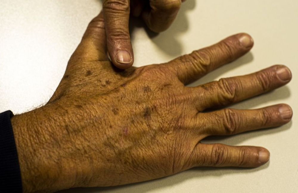 Tecnologia para tratar câncer de pele é aprovada para uso no SUS