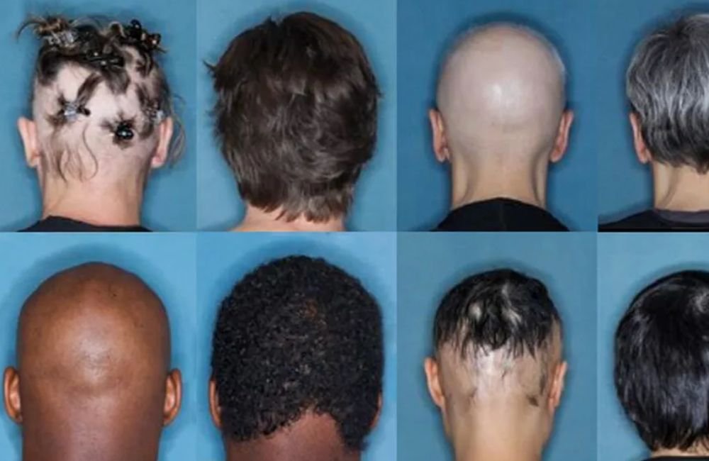 Novo remédio contra queda de cabelo é aprovado pela Anvisa: baricitinibe é usado contra artrite, dermatite e Covid