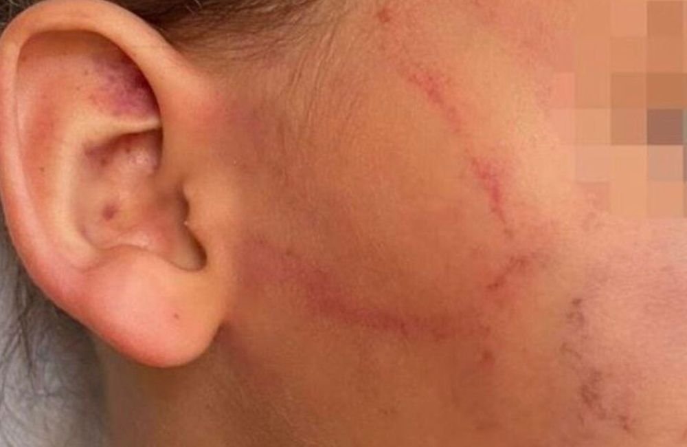 GO: Menina de 4 anos urina na roupa e tem rosto mordido pela mãe