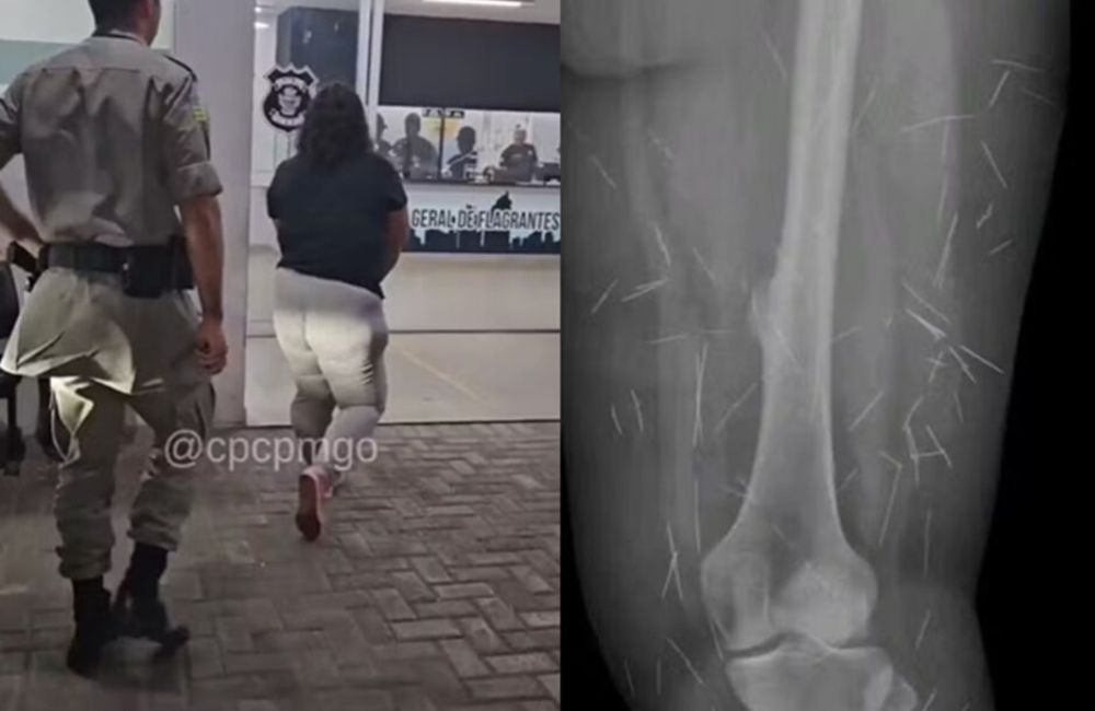 GO Mulher com 200 agulhas no corpo fingia ser criança para aplicar golpes