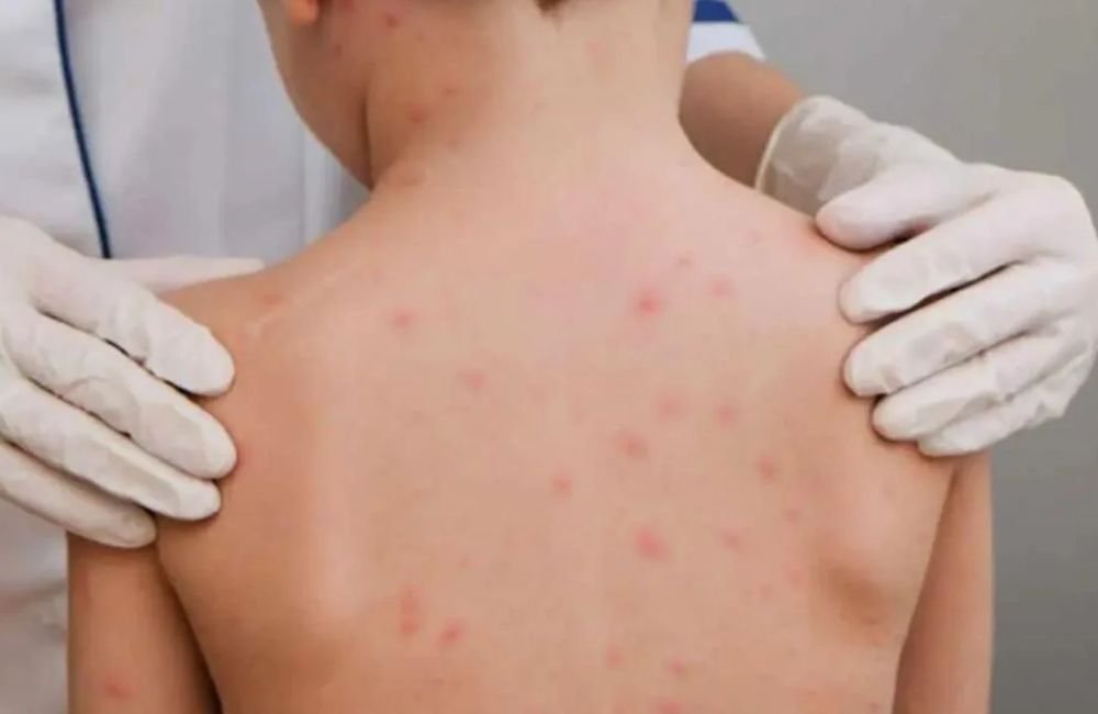 Governo de Goiás alerta sobre aumento de casos de meningite e recomenda vacinação; veja sintomas