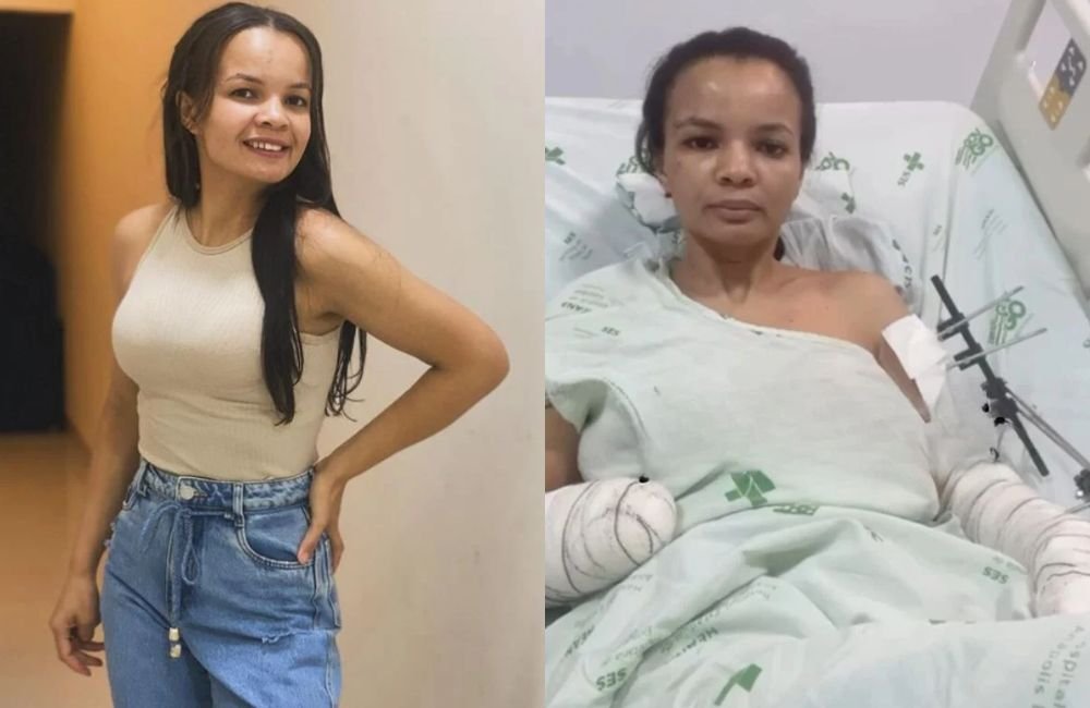 Jovem de Anápolis que teve a mão decepada pelo ex segue internada e busca ajuda para custear prótese