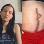 Jovem goiana vive meses de terror após ter gaze esquecida dentro do corpo em cesariana