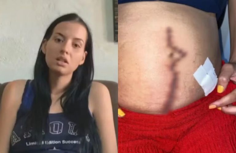 Jovem goiana vive meses de terror após ter gaze esquecida dentro do corpo em cesariana