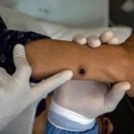 Mpox SP confirma primeiro caso brasileiro de nova cepa responsável por surto na África