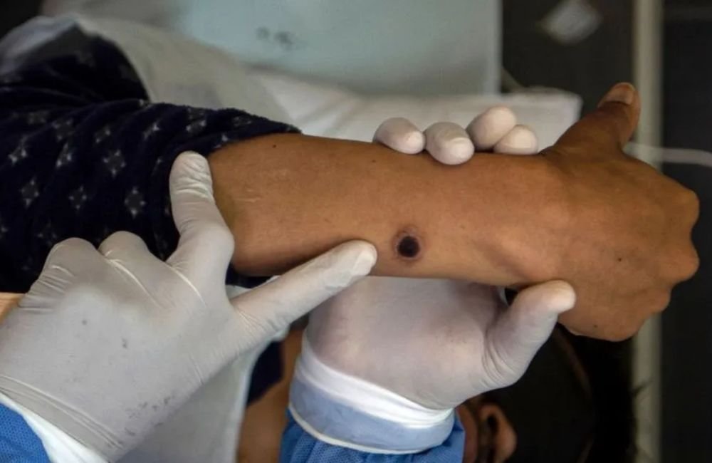 Mpox: SP confirma primeiro caso brasileiro de nova cepa responsável por surto na África