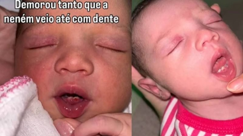 Bebê surpreende ao nascer com dois dentinhos em Rio Verde