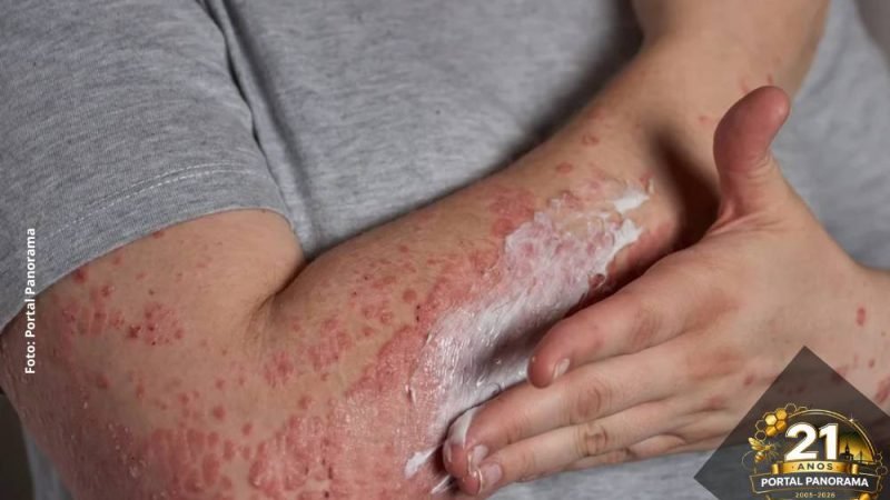 Estresse agrava dermatite atópica e estudo revela ligação direta entre cérebro e pele