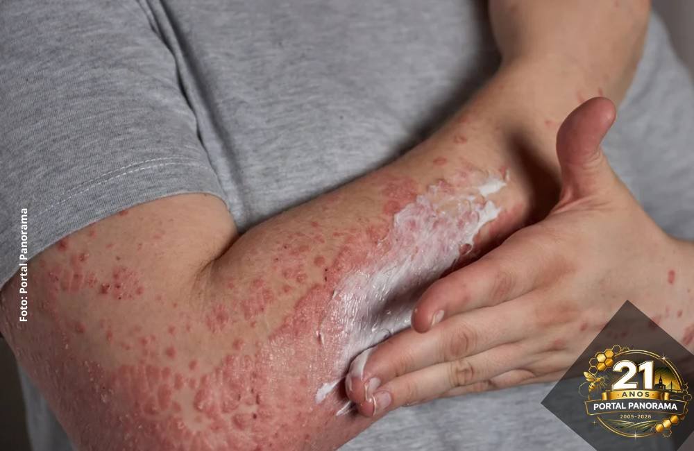 Estresse agrava dermatite atópica e estudo revela ligação direta entre cérebro e pele