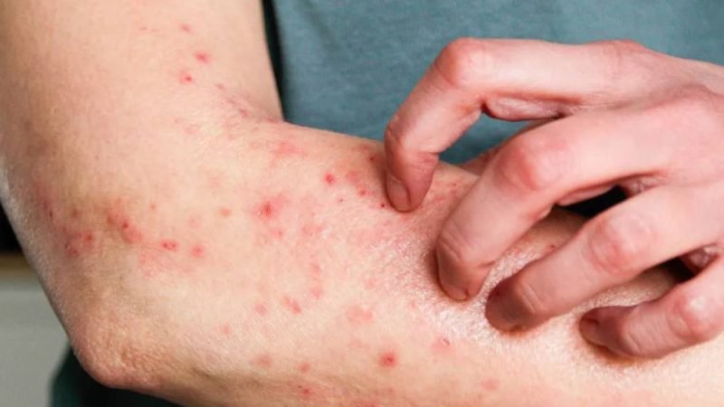 Mpox tem prevenção e diagnóstico disponíveis no Brasil e não é motivo para pânico