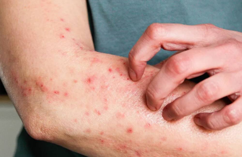 Mpox tem prevenção e diagnóstico disponíveis no Brasil e não é motivo para pânico