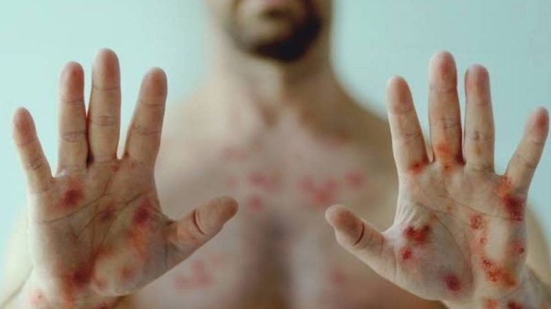 Goiás registra recorde de casos de sífilis em 2025; homens são maioria